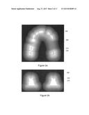 SURGICAL TEMPLATE diagram and image