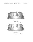 SURGICAL TEMPLATE diagram and image