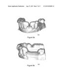 SURGICAL TEMPLATE diagram and image