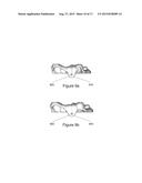 SURGICAL TEMPLATE diagram and image