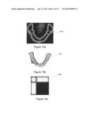 SURGICAL TEMPLATE diagram and image