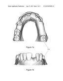 VIRTUAL SPLINT diagram and image