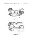 VIRTUAL SPLINT diagram and image