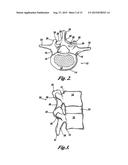 POLYAXIAL ADJUSTMENT OF FACET JOINT PROSTHESES diagram and image