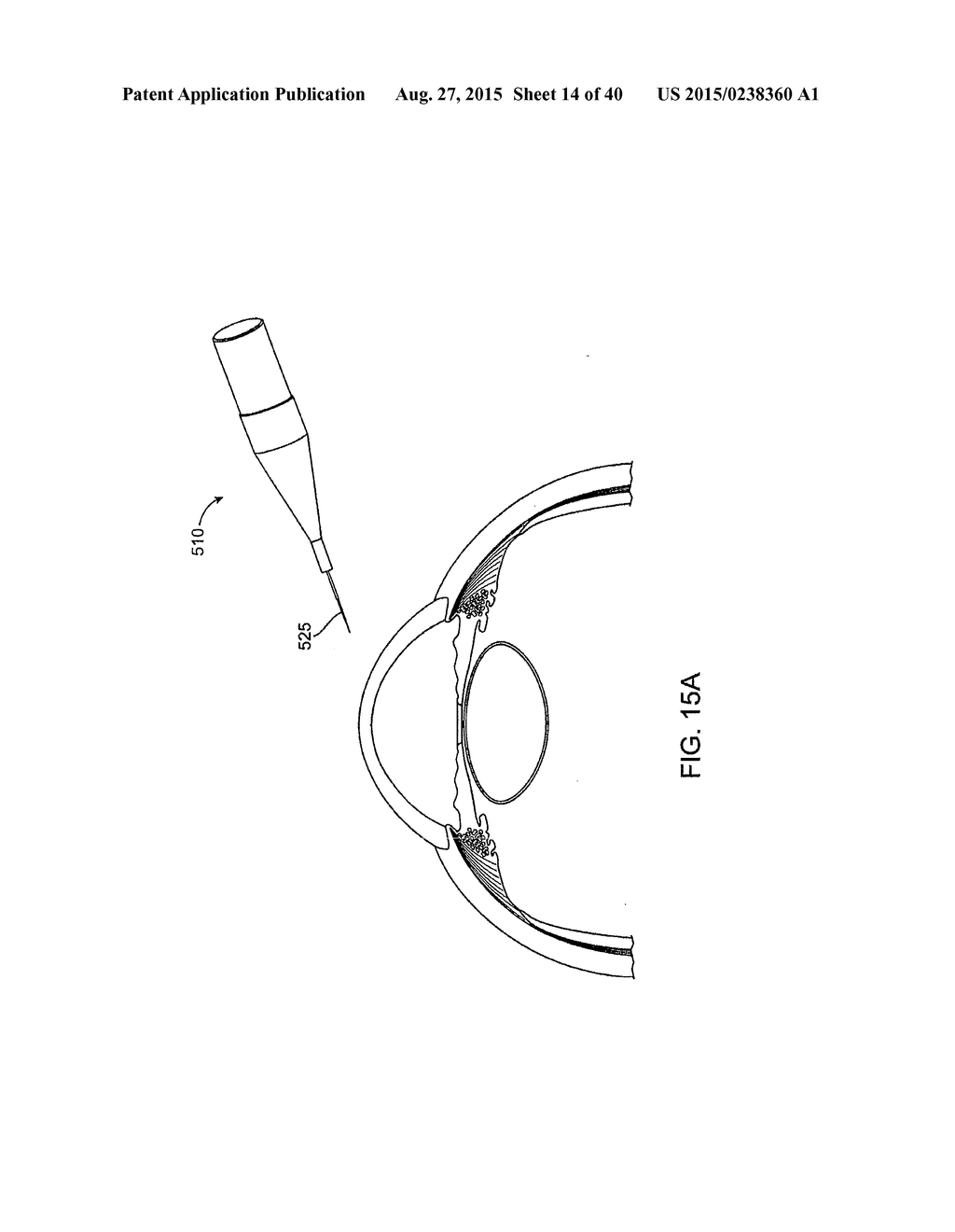 Glaucoma Treatment Device - diagram, schematic, and image 15