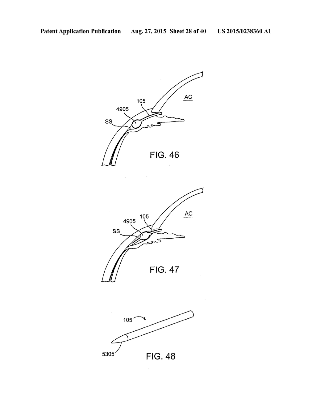 Glaucoma Treatment Device - diagram, schematic, and image 29