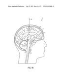 Method and System for Enhanced Imaging Visualization of Deep Brain Anatomy     Using Infusion diagram and image