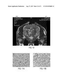 Method and System for Enhanced Imaging Visualization of Deep Brain Anatomy     Using Infusion diagram and image