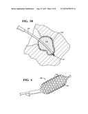 SYSTEMS FOR THE REDUCTION OF LEAKAGE AROUND MEDICAL DEVICES AT A TREATMENT     SITE diagram and image