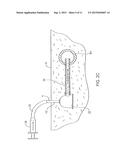 TRANSDERMAL VENOUS ACCESS LOCKING SOLUTIONS diagram and image