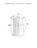 REMOVABLE ATTACHMENT OF A PASSIVE TRANSCUTANEOUS BONE CONDUCTION DEVICE     WITH LIMITED SKIN DEFORMATION diagram and image