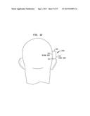 REMOVABLE ATTACHMENT OF A PASSIVE TRANSCUTANEOUS BONE CONDUCTION DEVICE     WITH LIMITED SKIN DEFORMATION diagram and image