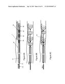 INTRAVASCULAR THROMBOEMBOLECTOMY DEVICE COMPRISING A PLURALITY OF CLOT     ENGAGING ELEMENTS AND METHOD USING THE SAME diagram and image