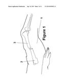 Method and Apparatus for Minimally Invasive Subcutaneous Treatment of Long     Bone Fractures diagram and image