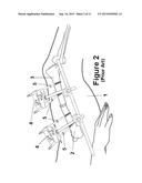 Method and Apparatus for Minimally Invasive Subcutaneous Treatment of Long     Bone Fractures diagram and image