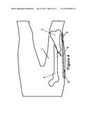 Method and Apparatus for Minimally Invasive Subcutaneous Treatment of Long     Bone Fractures diagram and image