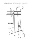 Method and Apparatus for Minimally Invasive Subcutaneous Treatment of Long     Bone Fractures diagram and image