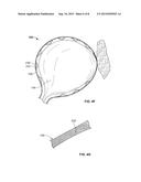 NESTED BALLOON CRYOTHERAPY diagram and image