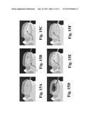 Wave Spring for a Spinal Implant diagram and image