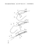 LACRIMAL DUCT TUBE diagram and image