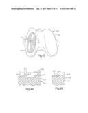 METHOD FOR PERFORMING SURGICAL PROCEDURES USING OPTICAL CUTTING GUIDES diagram and image