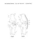 METHOD FOR PERFORMING SURGICAL PROCEDURES USING OPTICAL CUTTING GUIDES diagram and image