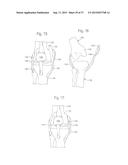 METHOD FOR PERFORMING SURGICAL PROCEDURES USING OPTICAL CUTTING GUIDES diagram and image