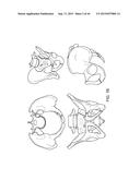 SHAPE ADAPTABLE INTRAMEDULLARY FIXATION DEVICE diagram and image