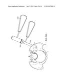 SHAPE ADAPTABLE INTRAMEDULLARY FIXATION DEVICE diagram and image