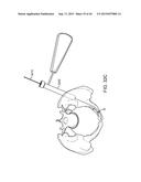 SHAPE ADAPTABLE INTRAMEDULLARY FIXATION DEVICE diagram and image