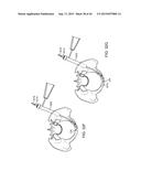 SHAPE ADAPTABLE INTRAMEDULLARY FIXATION DEVICE diagram and image