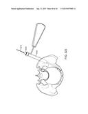 SHAPE ADAPTABLE INTRAMEDULLARY FIXATION DEVICE diagram and image