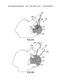 REMOVABLE DEPLOYMENT SYSTEM AND METHOD FOR IMPLANTABLE MESH PROSTHESES diagram and image