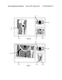 Method and System for Planning Implant Component Position diagram and image