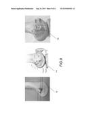 SYSTEM AND METHOD FOR LIGAMENT INSERTION IN KNEE JOINT SURGERIES USING     ADAPTIVE MIGRATION OF LIGAMENT INSERTION GEOMETRY diagram and image