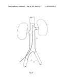 VASCULAR FILTER diagram and image