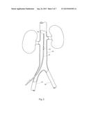 VASCULAR FILTER diagram and image