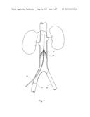 VASCULAR FILTER diagram and image