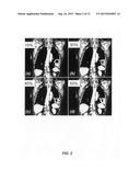 Including fiducial markers in radiation therapy planning to facilitate     real-time position monitoring during treatment delivery diagram and image