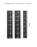 High Throughput Arrhythmia Risk Assessment Using Multilead Residua Signals diagram and image