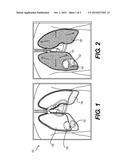 DEVICES AND METHODS FOR MODIFYING A VOLUME OF A CAVITY diagram and image