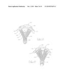 ORTHOPEDIC COMPRESSION PLATE AND METHOD OF SURGERY diagram and image