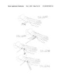 ORTHOPEDIC COMPRESSION PLATE AND METHOD OF SURGERY diagram and image