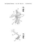 DEVICES FOR FORMING COLLATERAL CHANNELS AND RELATED METHODS OF USE diagram and image