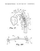 Sealable Endovascular Implants and Methods for Their Use diagram and image