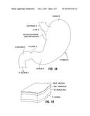 RESTRICTIVE AND/OR OBSTRUCTIVE IMPLANT FOR INDUCING WEIGHT LOSS diagram and image