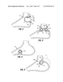 RESTRICTIVE AND/OR OBSTRUCTIVE IMPLANT FOR INDUCING WEIGHT LOSS diagram and image