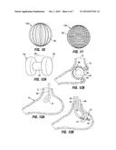 RESTRICTIVE AND/OR OBSTRUCTIVE IMPLANT FOR INDUCING WEIGHT LOSS diagram and image