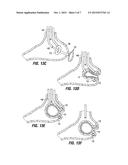 RESTRICTIVE AND/OR OBSTRUCTIVE IMPLANT FOR INDUCING WEIGHT LOSS diagram and image