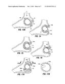 RESTRICTIVE AND/OR OBSTRUCTIVE IMPLANT FOR INDUCING WEIGHT LOSS diagram and image